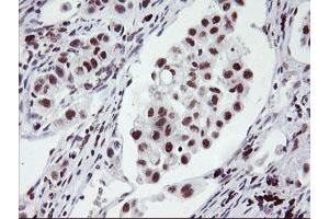 Immunohistochemical staining of paraffin-embedded Carcinoma of Human lung tissue using anti-RNF113B mouse monoclonal antibody. (RNF113B Antikörper)