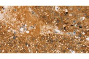 Immunohistochemistry of paraffin-embedded Human breast cancer using TBC1D4 Polyclonal Antibody at dilution of 1:40 (TBC1D4 Antikörper)