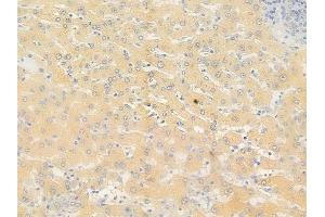 ABIN6256178 and ABIN6267536 at 1/100 staining human hepatocellular carcinoma by IHC-P.