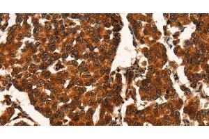 Immunohistochemistry of paraffin-embedded Human breast cancer using CUEDC2 Polyclonal Antibody at dilution of 1:50 (CUEDC2 Antikörper)