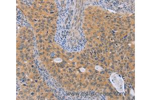 Immunohistochemistry of Human cervical cancer using BRS3 Polyclonal Antibody at dilution of 1:50 (BRS3 Antikörper)