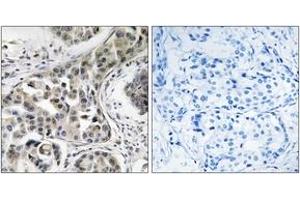 Immunohistochemistry analysis of paraffin-embedded human breast carcinoma, using USP6NL Antibody.