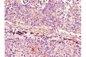 Immunohistochemistry of paraffin-embedded human cervical cancer using  at dilution of 1:100 (CDKN2A Antikörper  (AA 1-86))