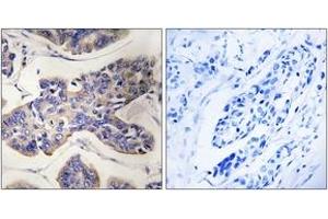 Immunohistochemistry analysis of paraffin-embedded human breast carcinoma tissue, using TAOK1 Antibody.