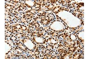 The image on the left is immunohistochemistry of paraffin-embedded Human thyroid cancer tissue using ABIN7192627(SPATA20 Antibody) at dilution 1/70, on the right is treated with synthetic peptide. (SPATA2 Antikörper)