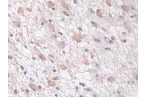 Detection of tPK1 in Human Glioma Tissue using Polyclonal Antibody to Tau-Protein Kinase 1 (tPK1) (TPK1 Antikörper  (AA 34-300))