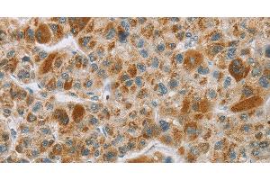 Immunohistochemistry of paraffin-embedded Human liver cancer tissue using CYP27A1 Polyclonal Antibody at dilution 1:50 (CYP27A1 Antikörper)