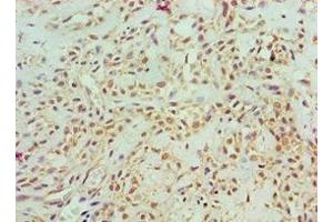 Immunohistochemistry of paraffin-embedded human breast cancer using ABIN7143157 at dilution of 1:100 (ASCC3 Antikörper  (AA 1-111))
