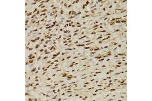 Immunohistochemistry of paraffin-embedded Human adenomyosis using ANP32A antibody at dilution of 1:100 (x400 lens). (PHAP1 Antikörper)