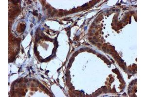 Immunohistochemical staining of paraffin-embedded Human breast tissue using anti-CYB5R3 mouse monoclonal antibody. (CYB5R3 Antikörper)