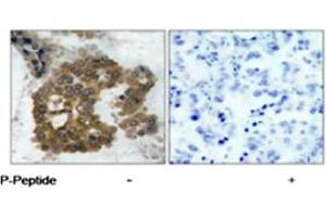 Immunohistochemical analysis of paraffin-embedded human lung carcinoma tissue using AKT2 (phospho S474) polyclonal antibody .
