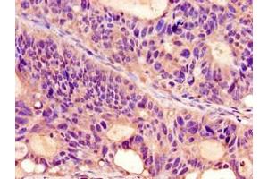Immunohistochemistry of paraffin-embedded human colon cancer using ABIN7164713 at dilution of 1:100 (Prokineticin Receptor 2 Antikörper  (AA 1-45))