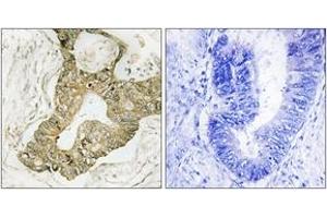 Immunohistochemistry analysis of paraffin-embedded human breast carcinoma tissue, using p90 RSK (Ab-380) Antibody. (RPS6KA3 Antikörper  (AA 346-395))