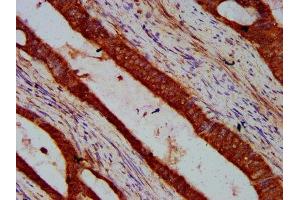 IHC image of ABIN7169218 diluted at 1:600 and staining in paraffin-embedded human colon cancer performed on a Leica BondTM system. (VRK2 Antikörper  (AA 317-472))