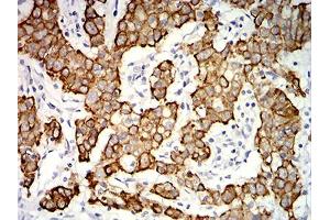Immunohistochemical analysis of paraffin-embedded stomach cancer tissues using KRT19 mouse mAb with DAB staining. (Cytokeratin 19 Antikörper  (AA 274-400))