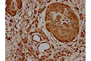 IHC image of ABIN7154863 diluted at 1:700 and staining in paraffin-embedded human pancreatic cancer performed on a Leica BondTM system. (HSP70 1A Antikörper  (AA 291-641))