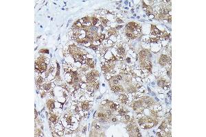 Immunohistochemistry of paraffin-embedded human liver cancer using MT2A Rabbit pAb (ABIN3015841, ABIN3015842, ABIN3015843 and ABIN6219186) at dilution of 1:150 (40x lens). (MT2A Antikörper  (AA 1-61))