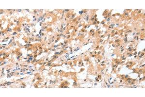 Immunohistochemistry of paraffin-embedded Human thyroid cancer using CIDEC Polyclonal Antibody at dilution of 1:50