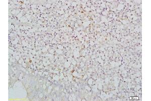 Formalin-fixed and paraffin embedded human nasopharyngeal carcinoma labeled with Anti-NKG2D/CD314/KLRK1 Polyclonal Antibody, Unconjugated  at 1:200, followed by conjugation to the secondary antibody and DAB staining (KLRK1 Antikörper  (AA 121-219))