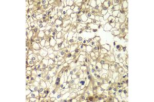 Immunohistochemistry of paraffin-embedded human kidney cancer using CD1D antibody (ABIN6292676) at dilution of 1:200 (40x lens). (CD1d Antikörper)