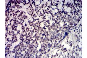 Immunohistochemical analysis of paraffin-embedded esophageal cancer tissues using TBP mouse mAb with DAB staining. (TBP Antikörper  (AA 1-144))