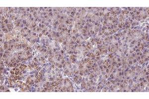 ABIN6273254 at 1/100 staining Human pancreas cancer tissue by IHC-P. (HBS1L Antikörper  (N-Term))