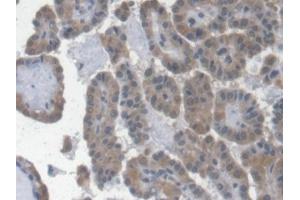 Detection of EPO in Human Thyroid cancer Tissue using Monoclonal Antibody to Erythropoietin (EPO) (EPO Antikörper  (AA 28-193))