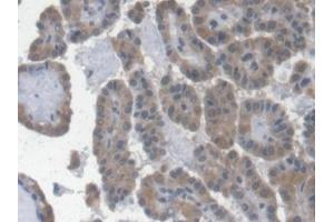 Detection of EPO in Human Thyroid cancer Tissue using Monoclonal Antibody to Erythropoietin (EPO)
