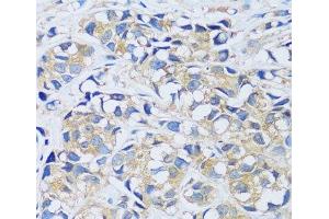 Immunohistochemistry of paraffin-embedded Human breast cancer using CABP7 Polyclonal Antibody at dilution of 1:100 (40x lens). (CABP7 Antikörper)
