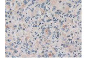 IHC-P analysis of Human Prostate Gland Cancer Tissue, with DAB staining. (TOR1A Antikörper  (AA 33-321))