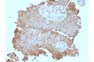 Formalin-fixed, paraffin-embedded human Bladder Carcinoma stained with Protocadherin FAT2 Monoclonal Antibody (8C5).