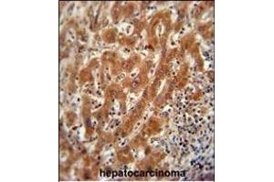 Pyruvate Kinase (PKM2) Antibody (C-term) (ABIN391053 and ABIN2837941) immunohistochemistry analysis in formalin fixed and paraffin embedded human hepatocarcinoma followed by peroxidase conjugation of the secondary antibody and DAB staining.