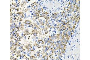 Immunohistochemistry of paraffin-embedded Human esophageal cancer using ACVR2A Polyclonal Antibody at dilution of 1:100 (40x lens). (ACVR2A Antikörper)
