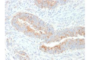 Formalin-fixed, paraffin-embedded human Colon Carcinoma stained with Erythropoietin (EPO) Mouse Monoclonal Antibody (EPO/1367). (EPO Antikörper  (AA 28-162))