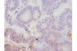 Immunohistochemistry of paraffin-embedded human colon cancer using ABIN7179111 at dilution of 1:100 (AVPR1A Antikörper  (AA 7-52))
