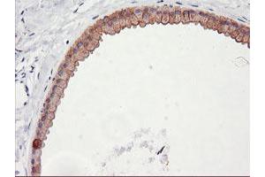 Immunohistochemical staining of paraffin-embedded Human breast tissue using anti-DGKA mouse monoclonal antibody. (DGKA Antikörper)