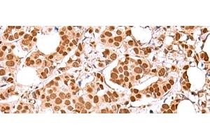 Immunohistochemistry of paraffin-embedded Human breast cancer tissue using RCOR3 Polyclonal Antibody at dilution of 1:60(x200) (RCOR3 Antikörper)
