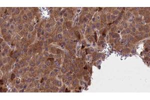 ABIN6277220 at 1/100 staining Human liver cancer tissue by IHC-P. (AP2M1 Antikörper  (Internal Region))