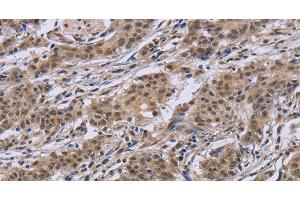 Immunohistochemistry of paraffin-embedded Human gastric cancer tissue using IPO8 Polyclonal Antibody at dilution 1:50 (Importin 8 Antikörper)
