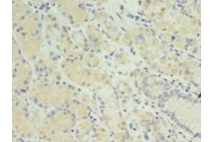 Immunohistochemistry of paraffin-embedded human gastric cancer using ABIN7165811 at dilution of 1:100 (MIS12 Antikörper  (AA 1-305))