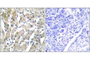 Immunohistochemistry analysis of paraffin-embedded human liver carcinoma tissue, using THRB Antibody.