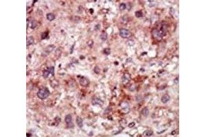 IHC analysis of FFPE human hepatocarcinoma stained with the GAK antibody (GAK Antikörper  (AA 15-45))