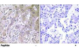 Immunohistochemistry analysis of paraffin-embedded human liver carcinoma tissue using ACOT12 polyclonal antibody . (ACOT12 Antikörper)