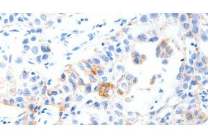 Immunohistochemistry of paraffin-embedded Human lung cancer tissue using MUC3A Polyclonal Antibody at dilution 1:60 (MUC3A Antikörper)