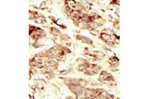 Formalin-fixed and paraffin-embedded human cancer tissue 8breast carcinoma) reacted with the primary antibody, which was peroxidase-conjugated to the secondary antibody, followed by DAB staining. (STK35 Antikörper  (Middle Region))