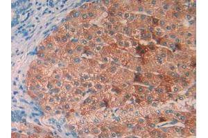 IHC-P analysis of Human Liver Cancer Tissue, with DAB staining. (IL1RAP Antikörper  (AA 420-558))