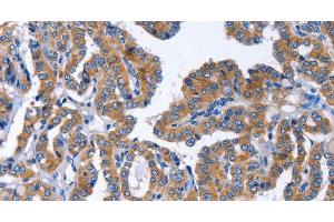 Immunohistochemistry of paraffin-embedded Human thyroid cancer tissue using IGSF10 Polyclonal Antibody at dilution 1:50 (IGSF10 Antikörper)
