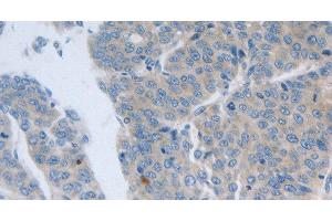 Immunohistochemistry of paraffin-embedded Human liver cancer tissue using GRIN1 Polyclonal Antibody at dilution 1:50 (GRIN1/NMDAR1 Antikörper)