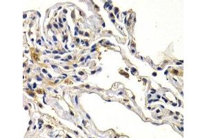 Immunohistochemistry of paraffin-embedded Human lung cancer using WNT3A Polyclonal Antibody at dilution of 1:200 (40x lens). (WNT3A Antikörper)