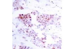 Immunohistochemistry analysis of paraffin-embedded human breast carcinoma tissue, using MEF2A (Ab-319) Antibody. (MEF2A Antikörper  (AA 296-345))